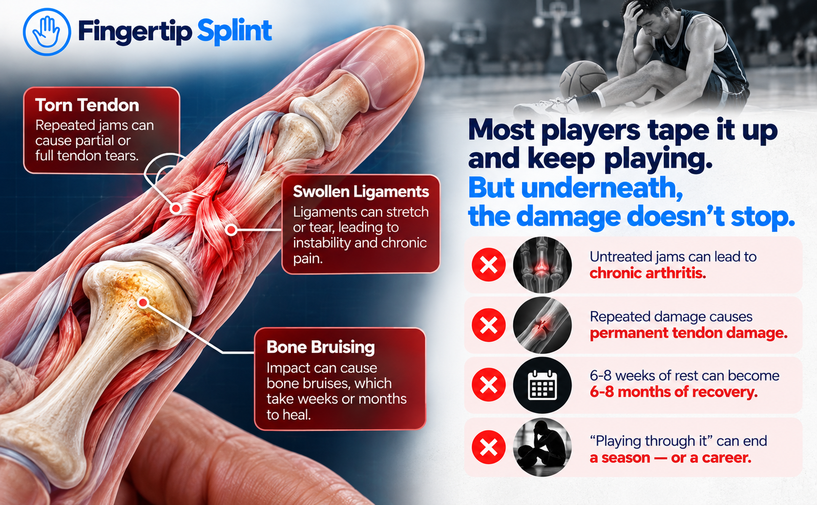 Finger joint anatomy and sports finger injury educational illustration by Fingertip Splint